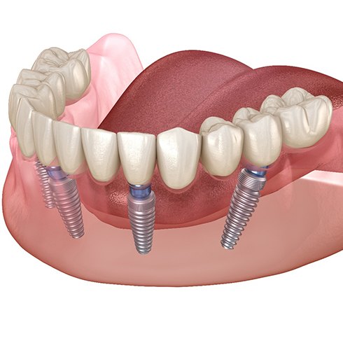 Illustrated model of All on 4 dental implants in Mineola on lower arch
