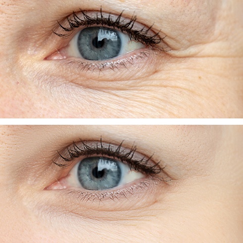 Close up of eye before and after treating wrinkles with Botox