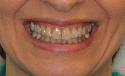 Close up of smile before dental veneers