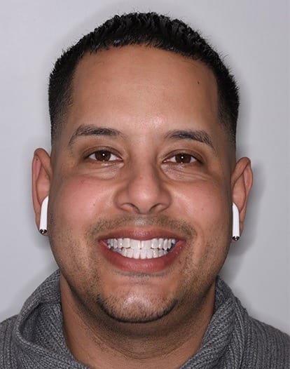 Man smiling after teeth whitening