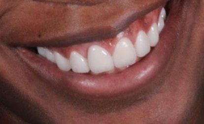 Close up of gorgeous healthy smile after veneers