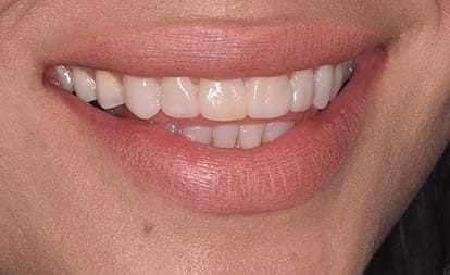 Close up of beautiful smile after veneers