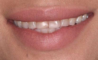 Close up of worn and discolored smile before veneers