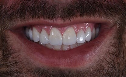 Close up of bright teeth and even gumline before gum surgery and veneers