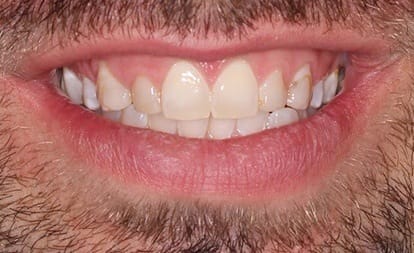 Close up of uneven teeth and gumline before gum surgery and veneers