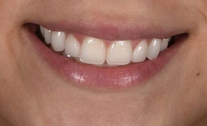 Close up of smile with even teeth after Invisalign and veneers