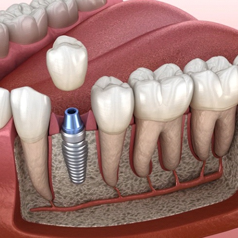 Illustrated dental crown being placed over a dental implant