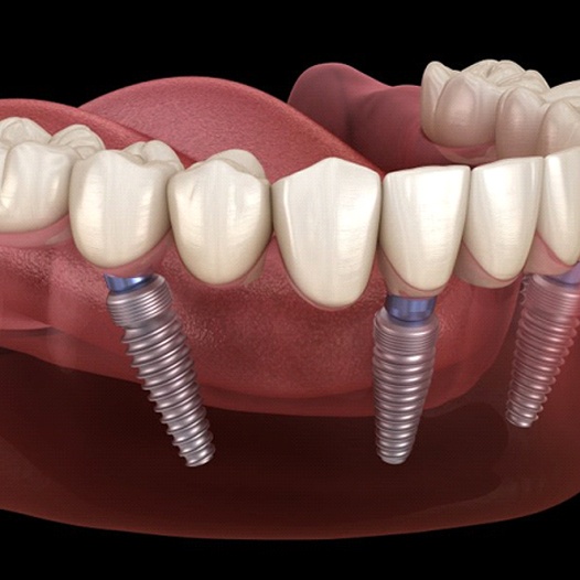 Close up of illustrated model of implant denture