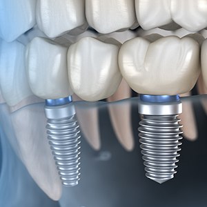 Illustrated dental bridge with two dental implants replacing three missing teeth