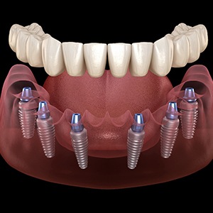 Illustrated full implant denture being placed onto six dental implants