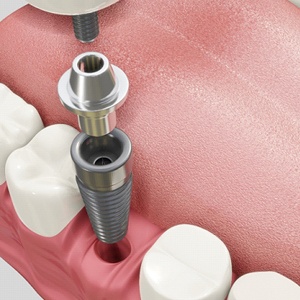 Illustrated abutment being fitted onto a dental implant