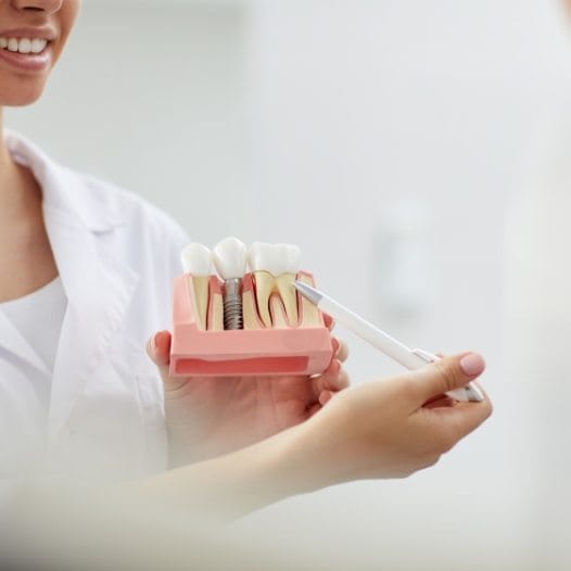 Dentist showing a dental implant model to a patient