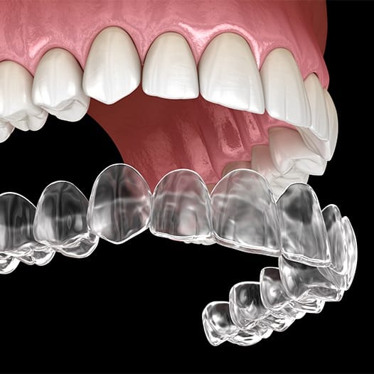 Illustrated Invisalign aligner being placed over upper row of teeth