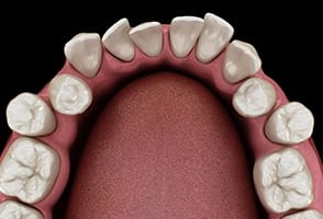 Illustrated arch of gapped teeth