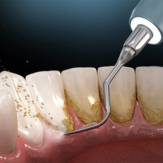 Illustrated dental scaler removing plaque buildup from teeth