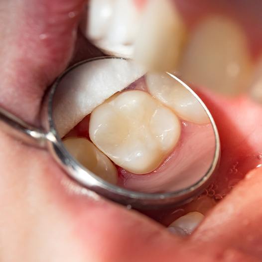 Close up of dental mirror reflecting a white tooth