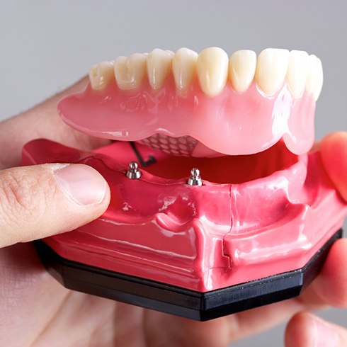 Mineola implant dentist holding model of All-On-4 dental implants