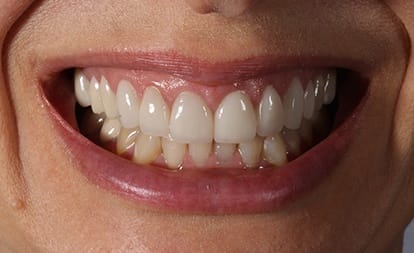 Closeup of patient's smile after cosmetic dentistry