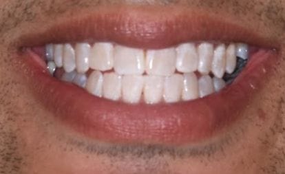 Closeup of man's bright white smile after cosmetic dentistry