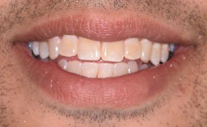Closeup of man's yellowed smile before cosmetic dentistry