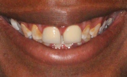 Patient's damaged and discolored smile before comprehensive dental care
