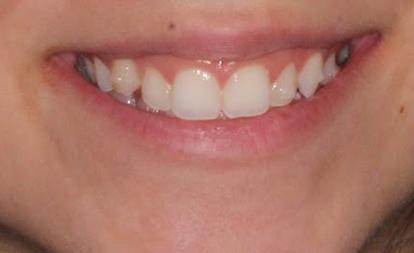 Closeup of young woman's smile before cosmetic dentistry