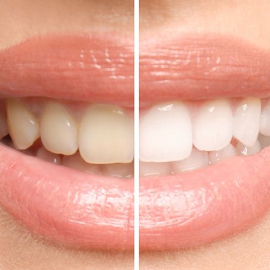 Close up of smile before and after teeth whitening