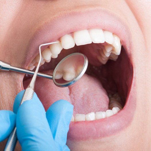 A close-up of a dental checkup in Mineola