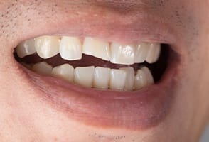 Closeup of smile with chipped front tooth