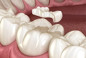 Animated smiling during tooth colored filling replacement