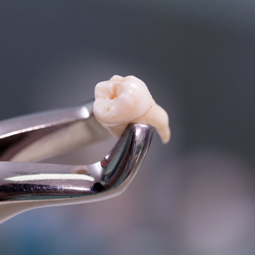 Dental forceps holding an extracted tooth