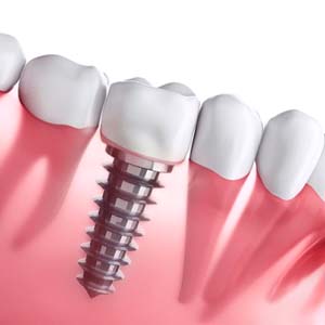 Illustrated dental implant replacing a missing lower tooth