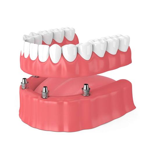 implant dentures in Mineola