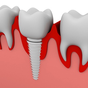 Illustration of a single dental implant in Mineola, NY