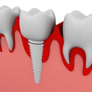 Illustrated dental implant with crown in lower jaw