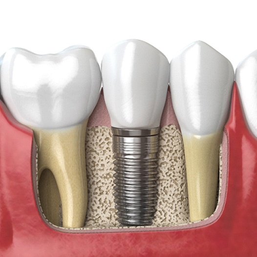 Diagram of an integrated dental implant in Mineola