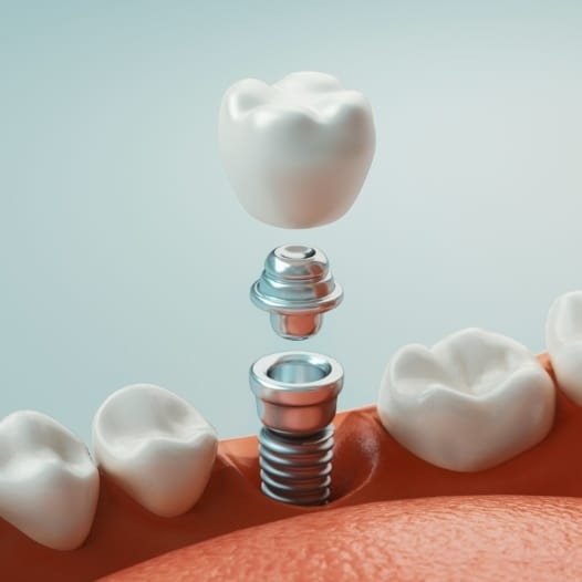 Illustrated dental implant being placed into the lower jaw