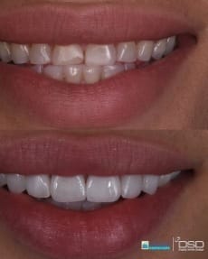 Before and after images of patient's smile