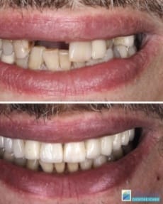 Closeup of smile before and after replacing missing teeth