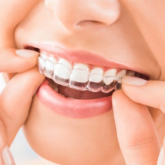 Close up of person placing Invisalign tray over their teeth