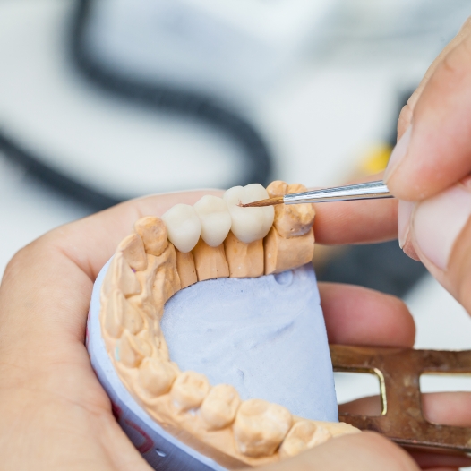 Dentist creating a dental bridge to replace missing teeth in Mineola