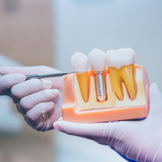 Dentist holding a model of a dental implant in the jaw