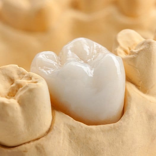 Dental crown covering a tooth in a model of the mouth