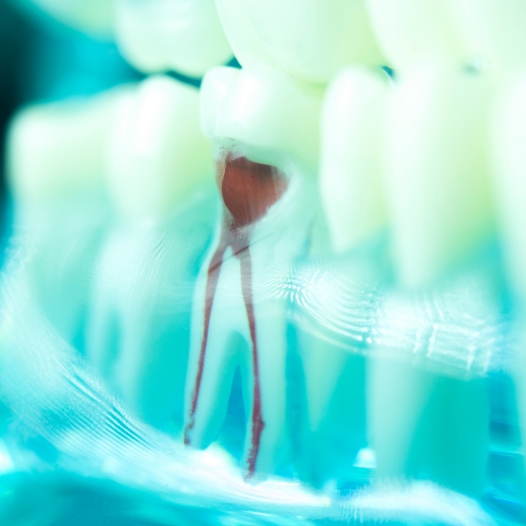Model of tooth showing root canal pathways inside of it