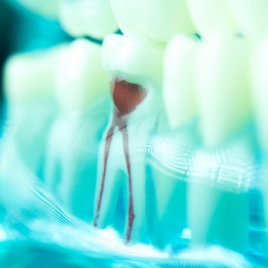 Model of tooth showing root canal pathways inside of it