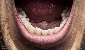 Closeup of the bottom of an open mouth