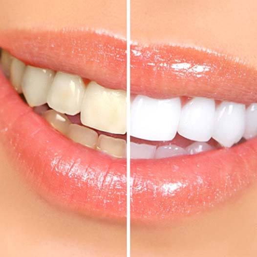 Smile before and after receiving teeth whitening in Mineola