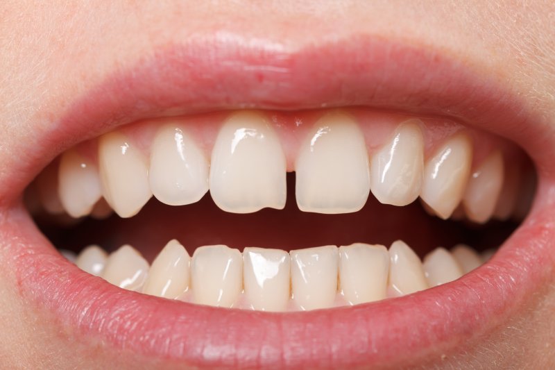 Gapped teeth, one of the most common cosmetic dental flaws