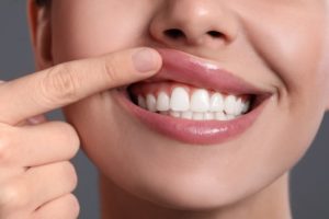 a person lifting up their lip to reveal their teeth